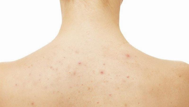 Triệt lông có gây viêm nang lông không?