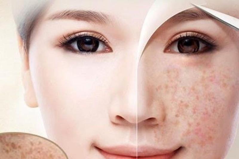 Viên uống trị nám tàn nhang hiệu quả