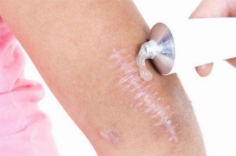 Chọn thuốc bôi trị ngứa hiệu quả