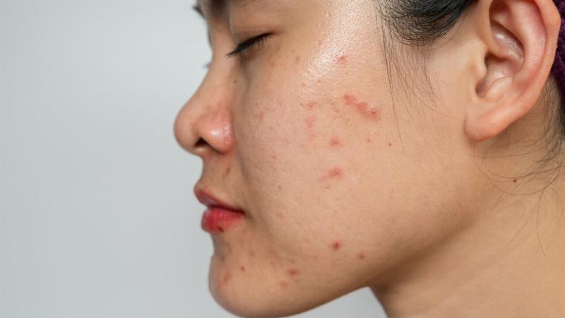cach-chua-mun-hieu-qua-va-an-toan