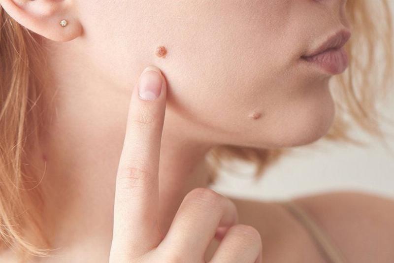 Tẩy nốt ruồi bằng phương pháp đốt điện