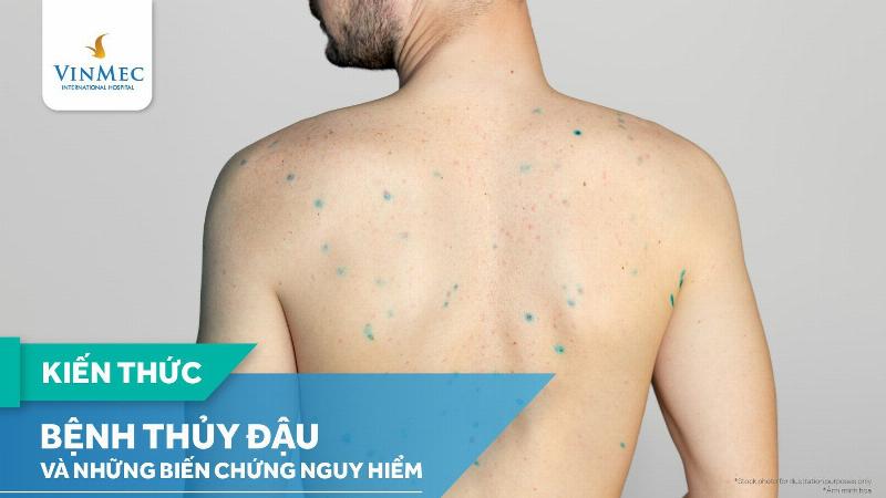 Hình ảnh mụn thủy đậu giai đoạn đầu: những vết ban đỏ nhỏ li ti