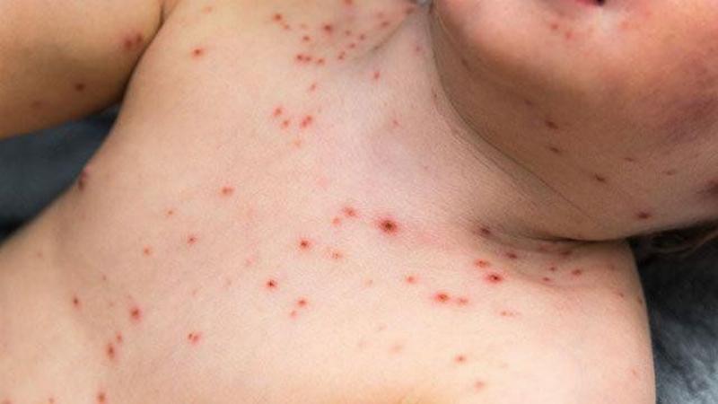 Hình ảnh mụn thủy đậu giai đoạn đóng vảy: các mụn nước khô lại tạo thành vảy màu nâu vàng