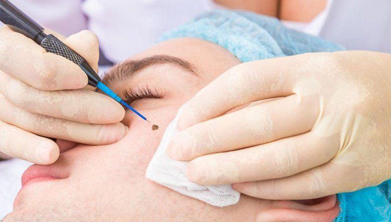 Tẩy nốt ruồi bằng Laser