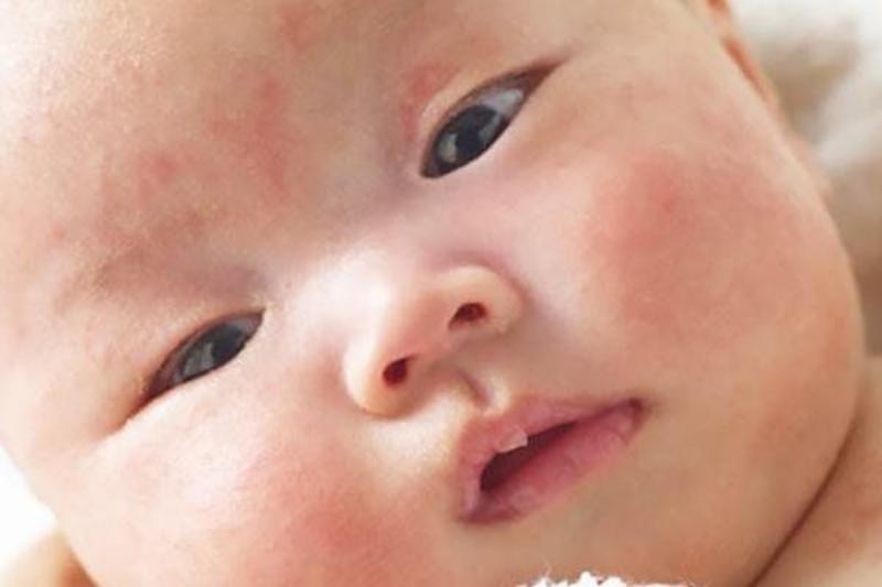 Hình ảnh mụn sữa ở trẻ sơ sinh