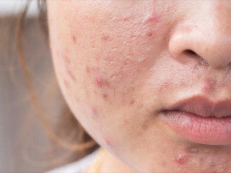 Hình ảnh mụn trứng cá sơ sinh