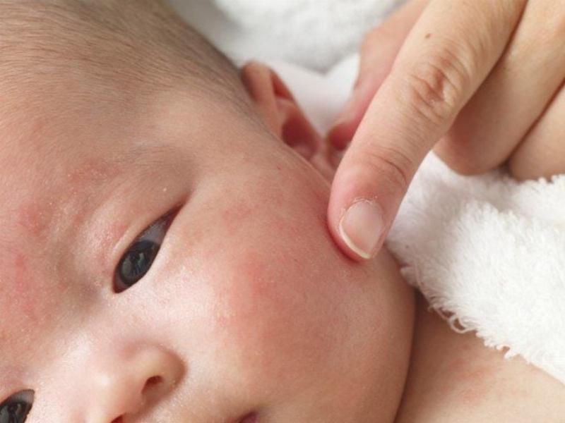 Hình ảnh mụn viêm ở trẻ sơ sinh